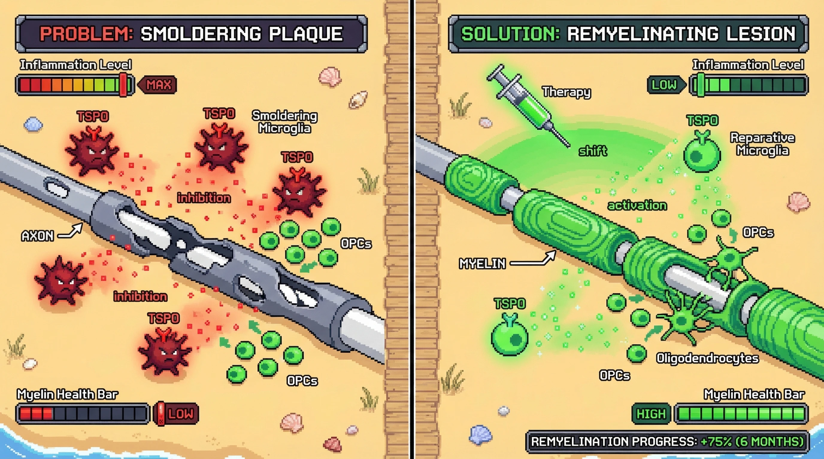 Infographic for: TSPO-PET Guided Therapy Converts Smoldering Plaques to Remyelinating Lesions
