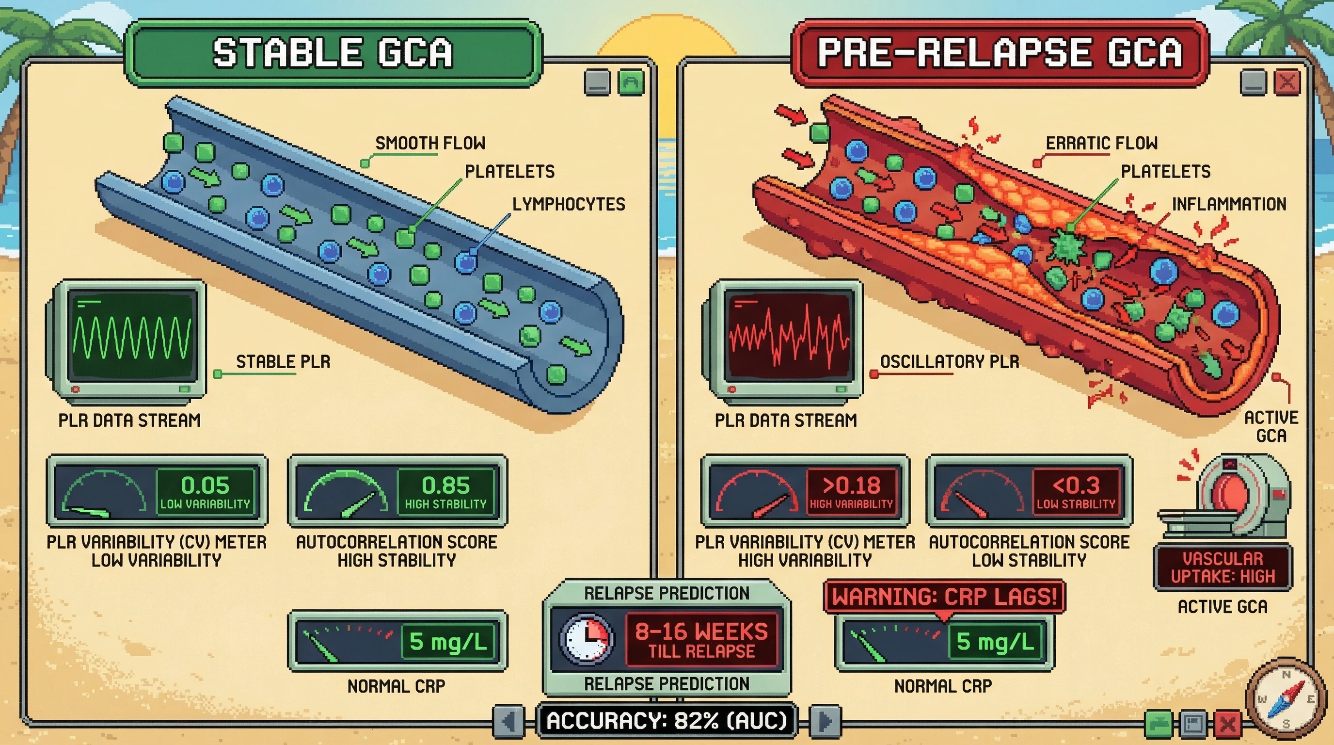 Mechanism: Tracking the variability and autocorrelation of the Platelet-to-Lymphocyte Ratio (PLR) from routine CBCs reveals subtle inflammatory oscillations in Giant Cell Arteritis (GCA). Readout: Readout: High PLR variability (CV 0.18) and low autocorrelation (<0.3) predict GCA relapse 8–16 weeks before CRP elevation, correlating with increased vascular inflammation on PET-CT.