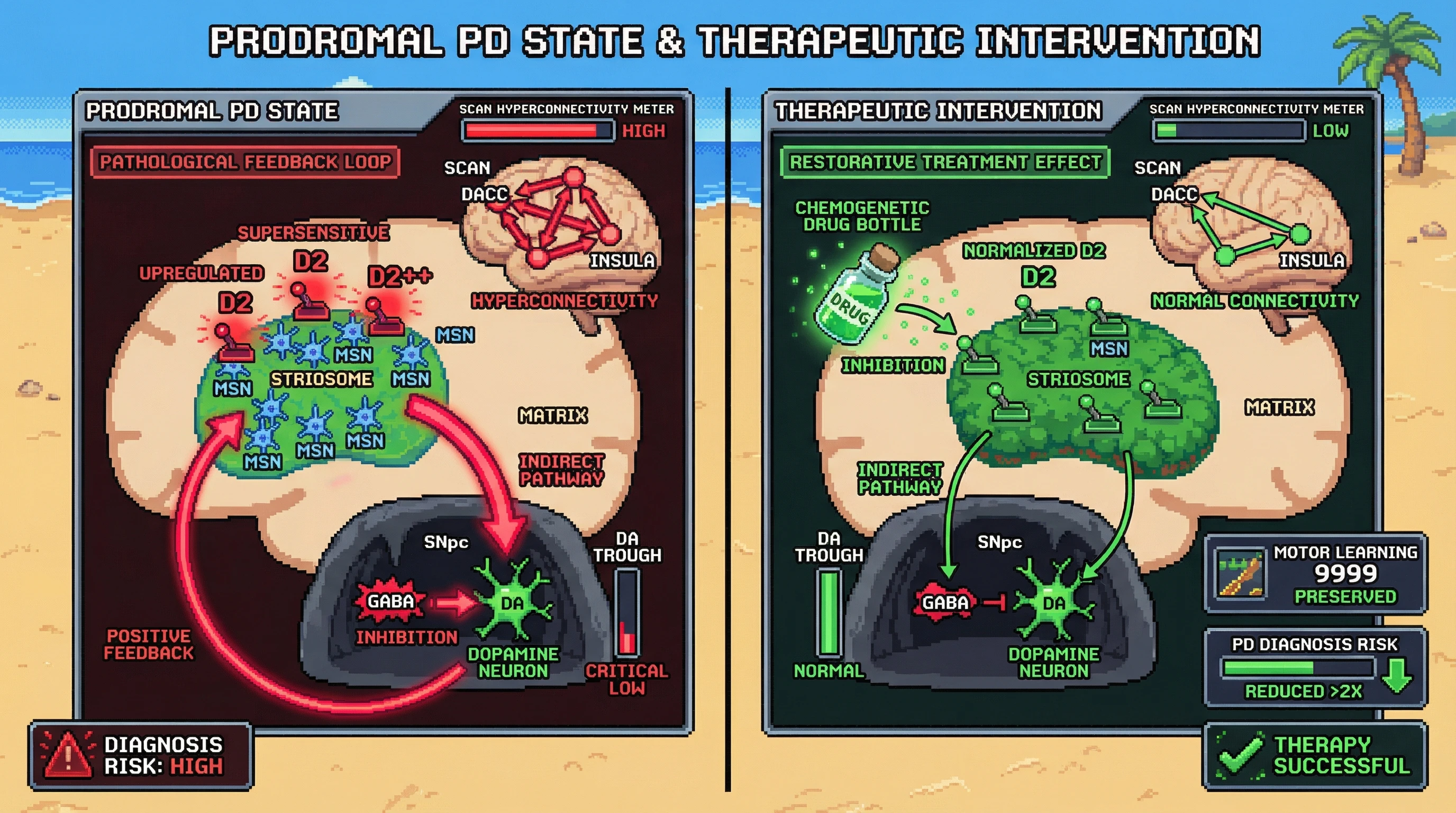 Infographic for: Striosome-Specific D2 Upregulation Precedes Nigral Loss and Drives SCAN Hyperconnectivity in Prodromal Parkinson's Disease