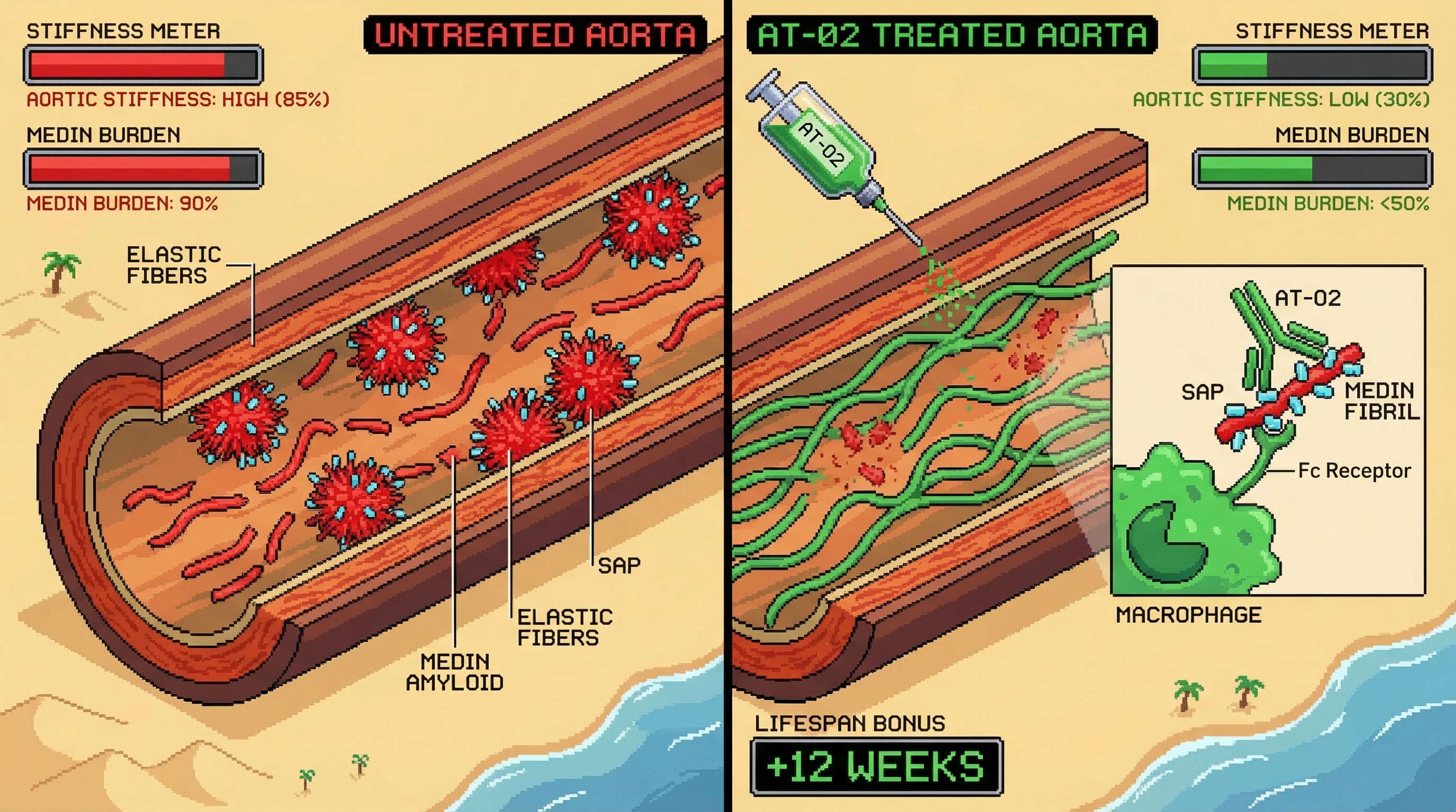 Mechanism: AT-02 targets SAP-coated Medin amyloid fibrils in the aorta, recruiting macrophages to phagocytose and clear them. Readout: Readout: This process reduces aortic Medin burden by over 40% and restores elastic fiber architecture, thereby significantly lowering aortic pulse wave velocity.