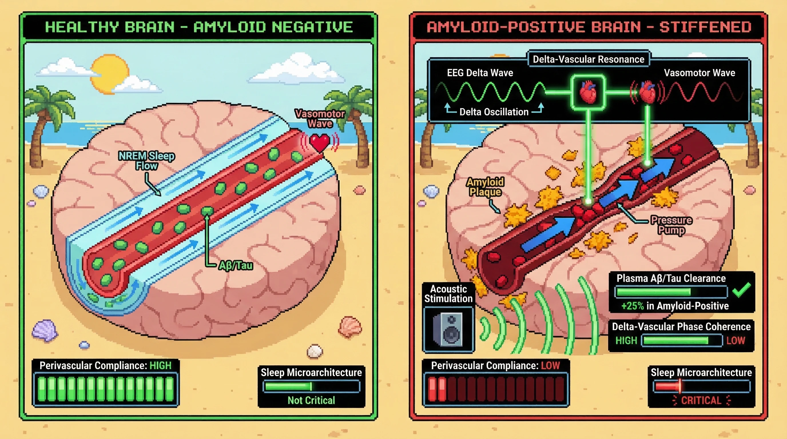 Infographic for: The Delta-Vascular Resonance Hypothesis: Glymphatic Clearance Becomes Mechanically Dependent on NREM Microarchitecture Only Following Incipient Amyloid Deposition