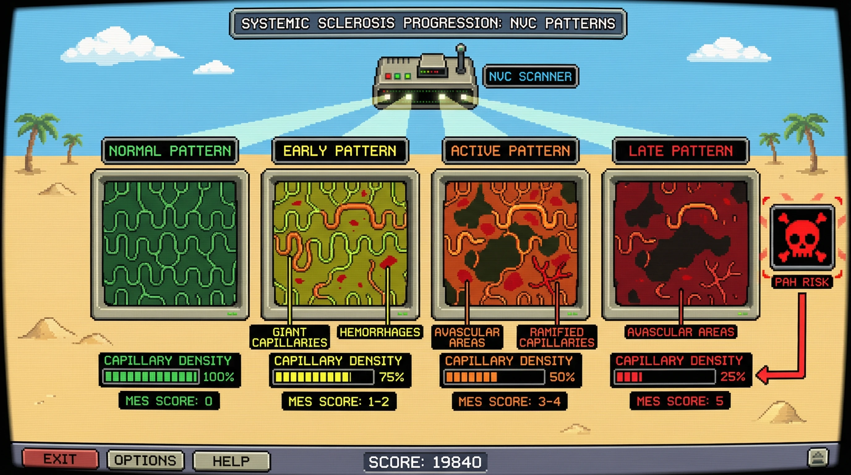 Infographic for: CAPILLAROSCOPY: Cutolo scleroderma pattern classification from nailfold videocapillaroscopy with Microangiopathy Evolution Score